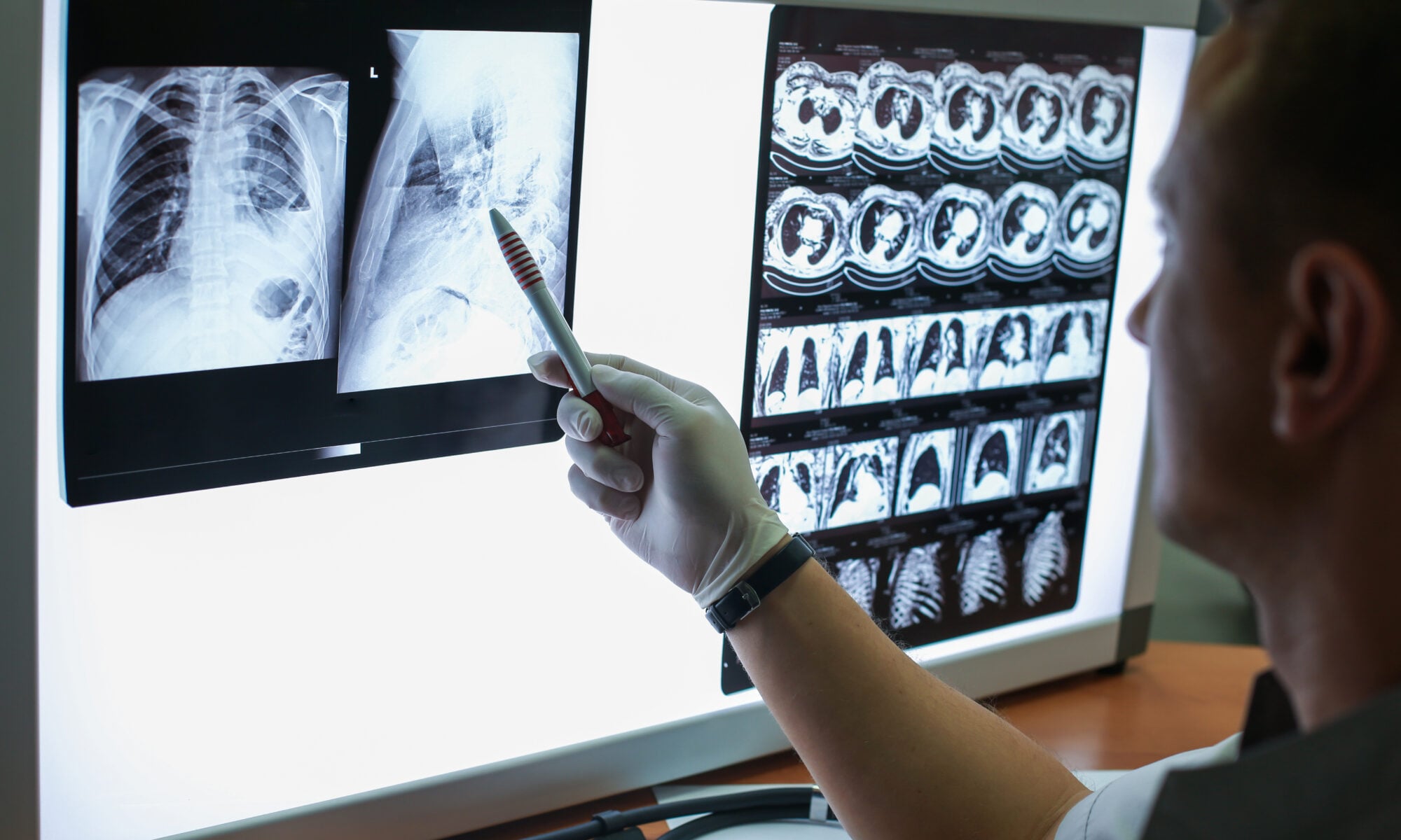 image of a provider looking at CT scans of the lung for lung cancer screening